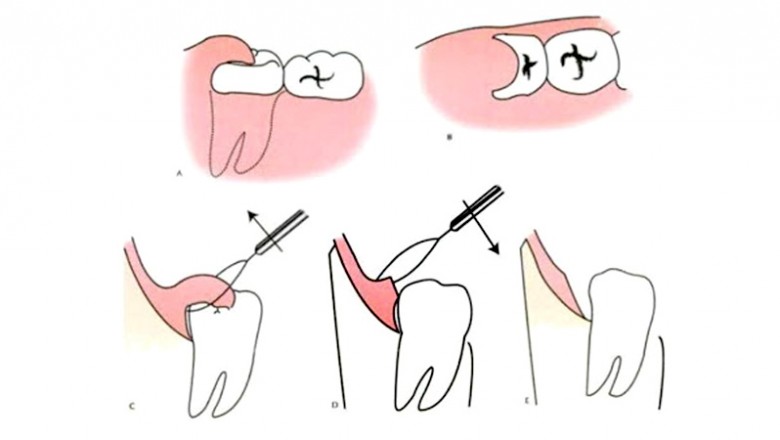What is Operculectomy and why is it performed
