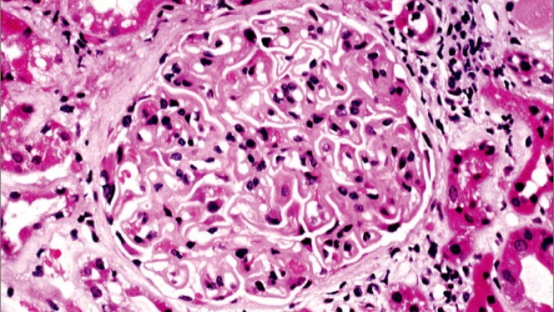 Idiopathic Membranous Nephropathy Treatment can be beneficial because the treatments target the disease directly