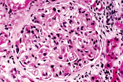 Idiopathic Membranous Nephropathy Treatment can be beneficial because the treatments target the disease directly