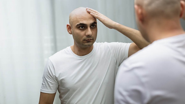 What Is the Perfect Age for a Hair Transplant?