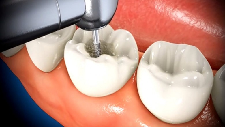 Root Canal Treatment - An Effective Means of Saving Infected Teeth