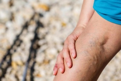 Varicose Vein Treatment Devices Assist Patients with Adequate Treatment for Varicose Veins