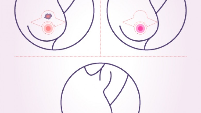 Breast Onco Surgery Surgeon in Delhi