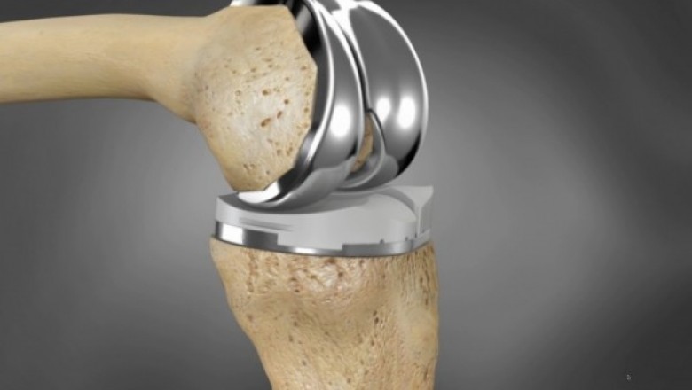 The global artificial joint market is oligopolistic, with a few companies controlling the majority of the market.