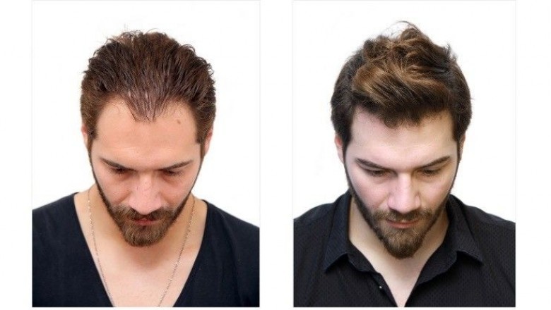 What Creates a Hair Transplant Successful?