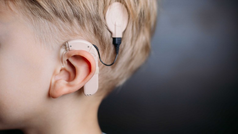 Cochlear Implants are a type of hearing aid that allows people with hearing loss to hear well and live a normal life