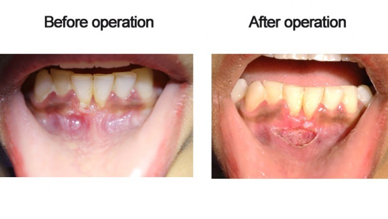 FRENOTOMY USING DIODE LASER
