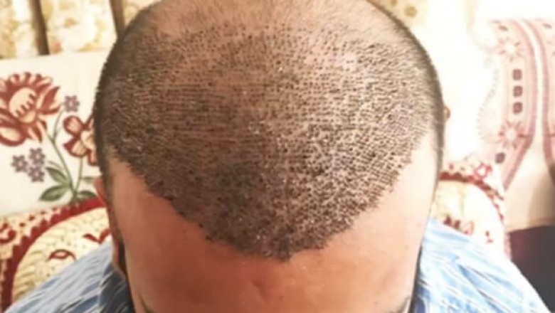 Which are the post-operative directions for Hair Transplant?
