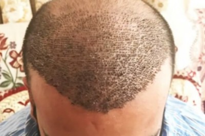 Which are the post-operative directions for Hair Transplant?
