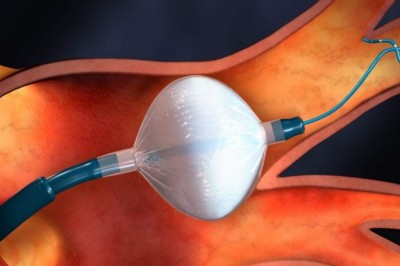 Cryoablation devices use extreme cold to shrink tumours as part of cancer treatment