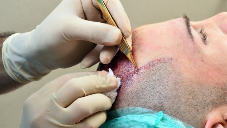 What is the best time to go swimming after a hair transplant?