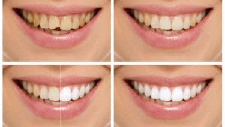 Cosmetic Dentistry Procedures
