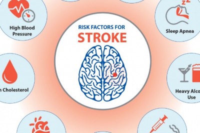 Risk Factors for Stroke | Best Mini Stroke Treatment