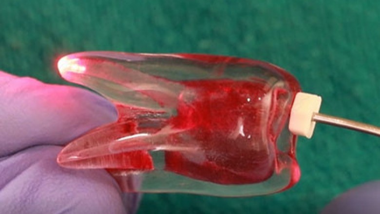 ROOT CANAL DISINFECTION IN PERMANENT TOOTH USING LASER DURING ROOT CANAL PROCEDURE/ENDODONTIC TREATM