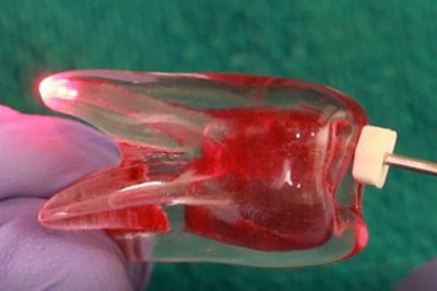 ROOT CANAL DISINFECTION IN PERMANENT TOOTH USING LASER DURING ROOT CANAL PROCEDURE/ENDODONTIC TREATM