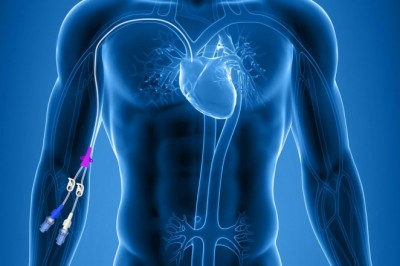 To obtain central access through peripheral veins, the tip of a peripherally implanted central catheter is used.