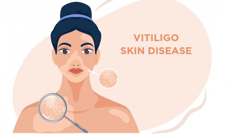 What are the options for Treating Vitiligo?