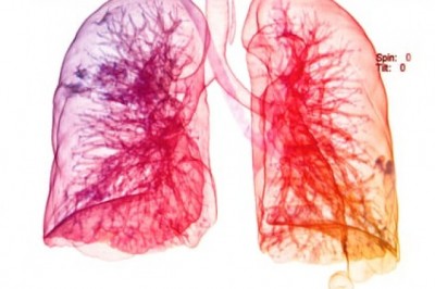 What are various respiratory distress syndrome treatment available in market today?