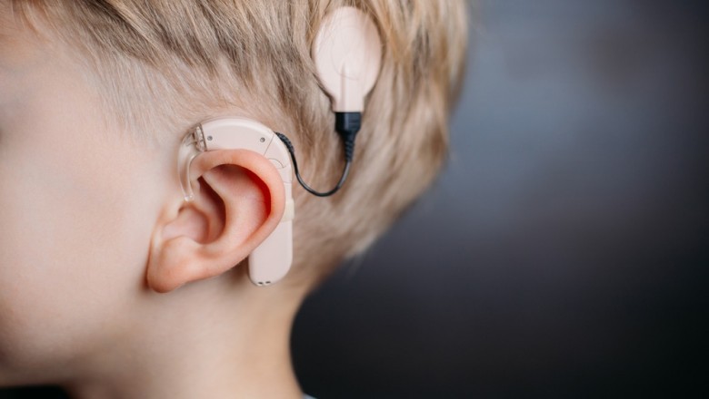 Cochlear Implants Are an Advanced Form of Hearing Aid That Helps Individuals Suffering From Hearing Loss to Hear Properly and Live a Normal Life