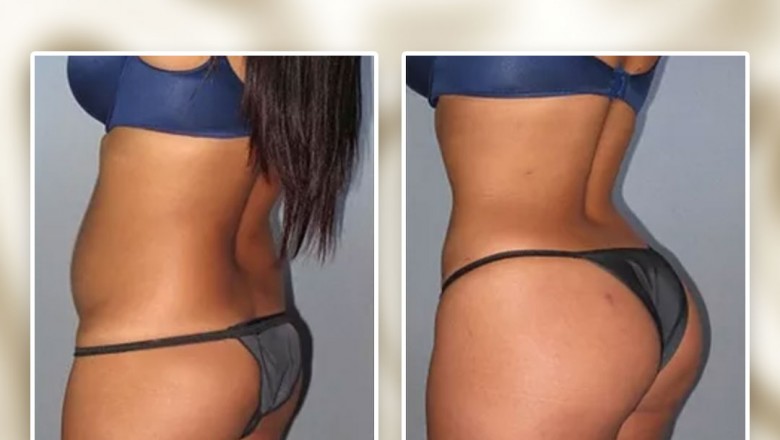 Why do we need Cavitation Machines For Fat Burning And Body Sculpting?