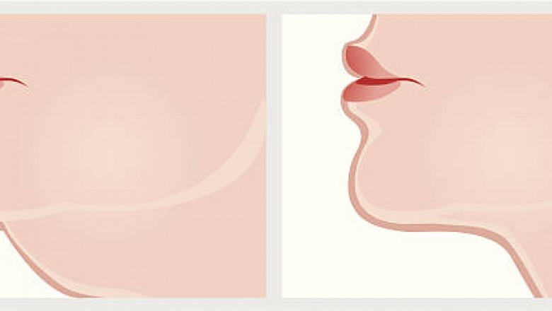 Kybella Near Me