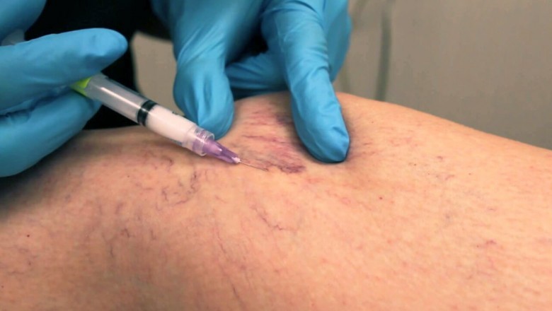 Vein Treatment: Can Leg Wedge Pillow Help You Eliminate Abnormal Veins?