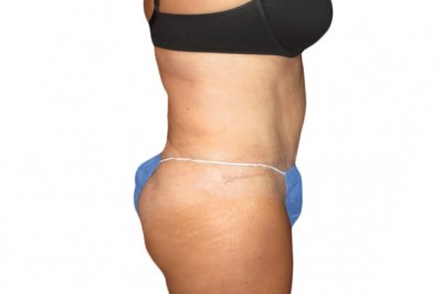 Brazilian Butt Lift and Its Benefits: