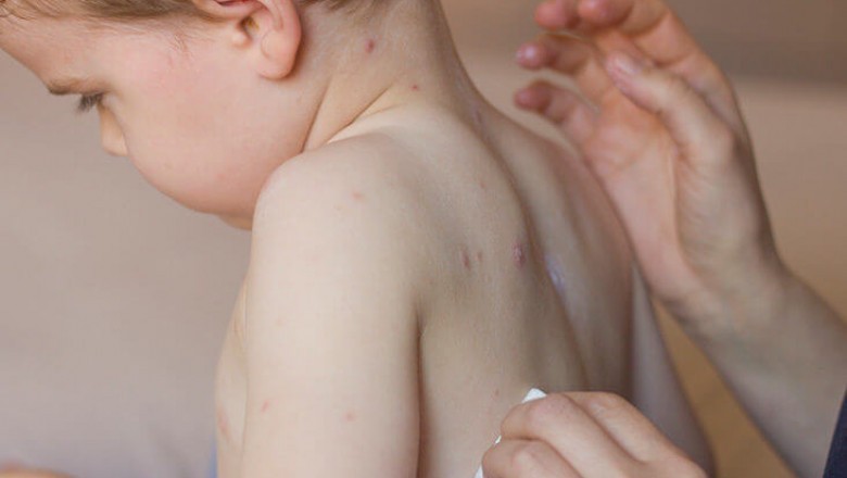 Essential Things You Need To Know About The Measles