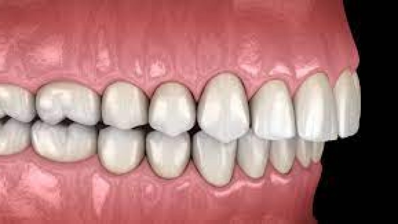 Overbite Before And After Braces