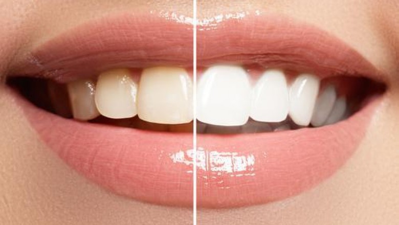 FAQ (Frequently Asked Questions) About Porcelain Veneers:
