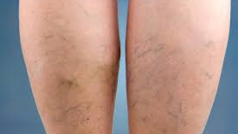 What is the best treatment for spider veins?