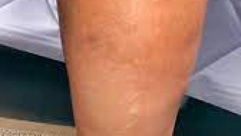 FAQ about vein problem and treaatment