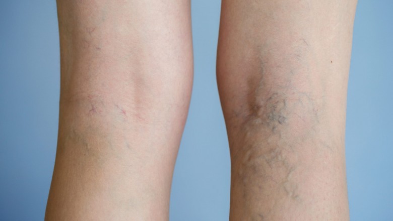 Is Microneedling good for your skin?