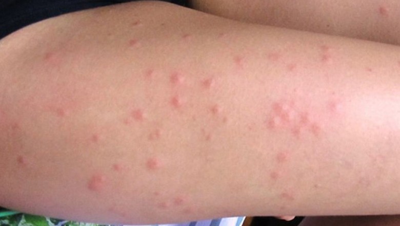 Leishmaniasis is a parasitic disease caused by Leishmania parasites and spread via the bite of an infected female phlebotomine sand flie
