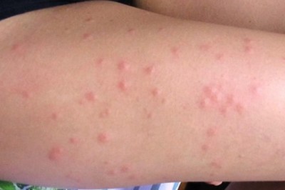 Leishmaniasis is a parasitic disease caused by Leishmania parasites and spread via the bite of an infected female phlebotomine sand flie