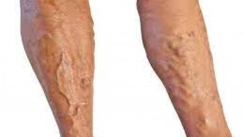 FiDi Vein Specialist Near Me