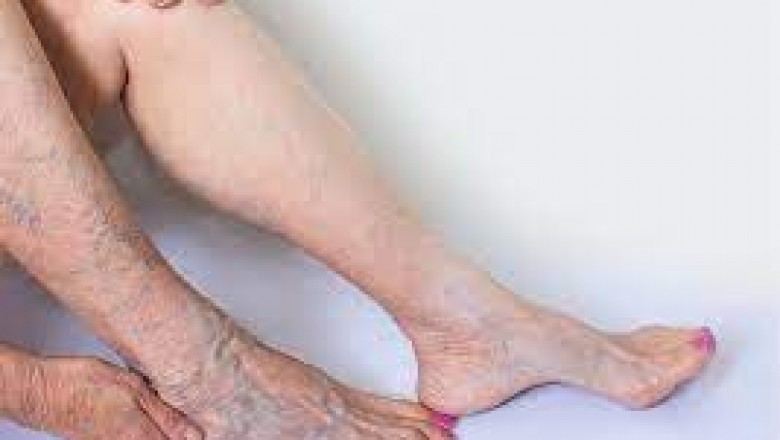 Memorial Vein Doctor Near Me
