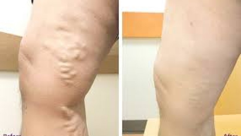 NJ Spider Vein Treatment Near Me
