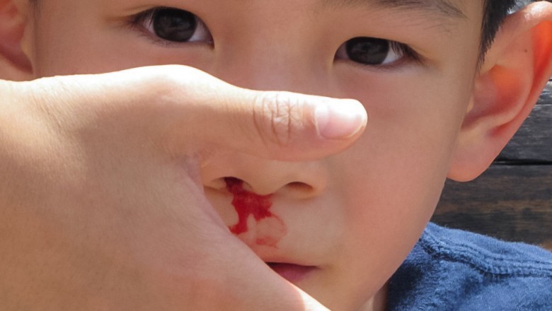 Summer Nosebleed: What Causes It and How to Treat It