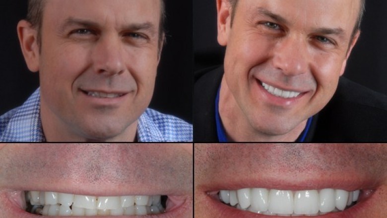 Porcelain Veneers Vienna