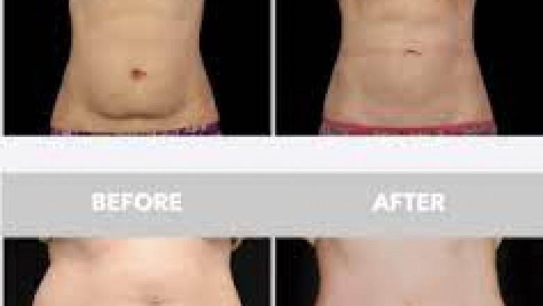 Coolsculpting Treatment Near Me
