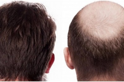 What Happens To Transplanted Hair?
