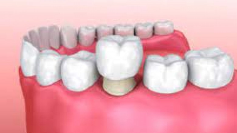 Wisdom Teeth Removal (Extraction)