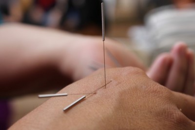 Dry Needling Therapy for Pain Relief