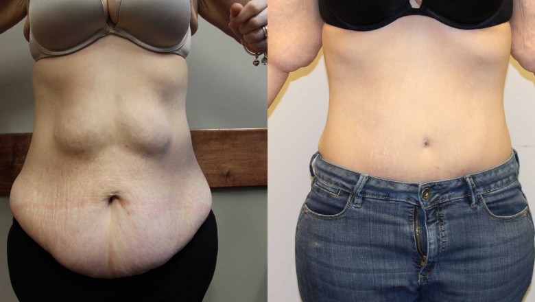 Tummy Tuck Before and After
