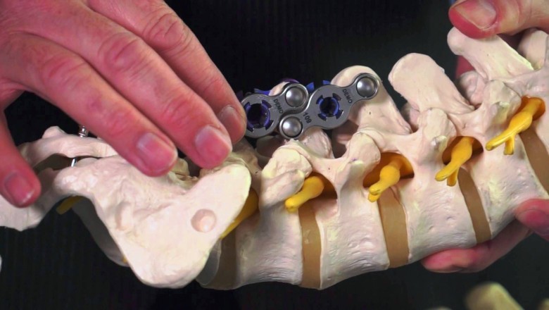 Demand for Spinal Non-Fusion Device Has Increased with Increasing Incidence of Spinal Injurie