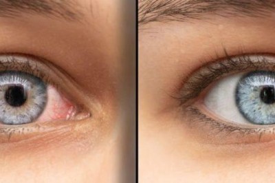 EYELID SURGERY: IMPORTANT FACTS YOU MUST KNOW ABOUT THE PROCEDURE