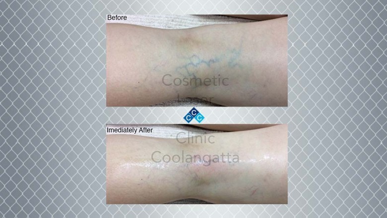 Non-Invasive Treatments to Get Rid of Spider Veins