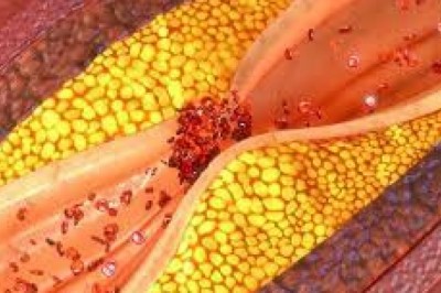 Treatments for hypertriglyceridemia; lifestyle and dietary changes can help lower high triglyceride levels