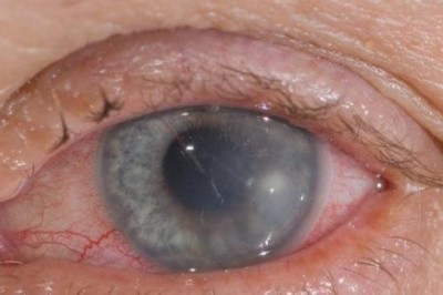 WHY CONTACT LENS WEARERS ARE AT A HIGHER RISK FOR CORNEAL ULCERS